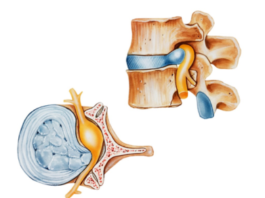 Disc Bulge treatment